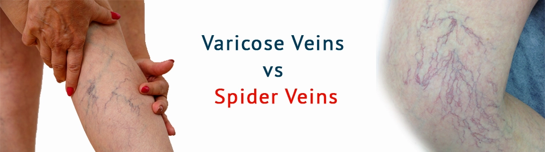 Difference Between Varicose Veins and Spider Veins